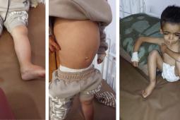 الطفل ياسر عرفات يعاني من سوء تغذية شديد ونقص خطير في الألبومين والبروتين