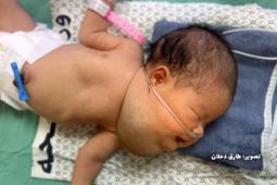 غياب الإمكانيات الطبية يجعل الأطباء عاجزين عن تحديد طبيعة التورم الذي تعاني منه الرضيعة حور قشطة