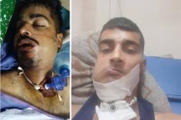 رصاصة متفجرة قطعت لسان معاذ الكحلوت، وكسرت فكيه