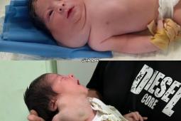 ناصر الخطيب.. رضيع يواجه مرضًا نادرًا في غزة