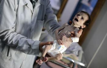 طفل في الغوطة الشرقية يعاني سوء التغذية (أ ف ب)