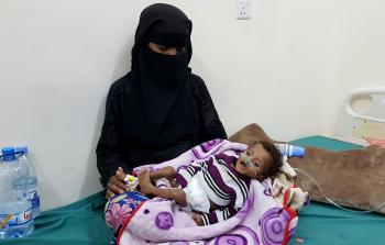 أطفال اليمن يعانون سوء التغذية (الأناضول)