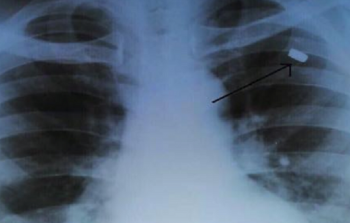 الرصاصة لم تضايقه طوال تلك السنوات حتى بدأ يشعر بالآلام