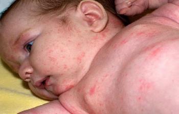 يشتهر فصل الصيف بالعديد من الأمراض وأنواع العدوى المختلفة