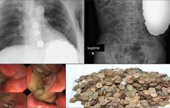 عثر الأطباء على 1894 قطعة معدنية