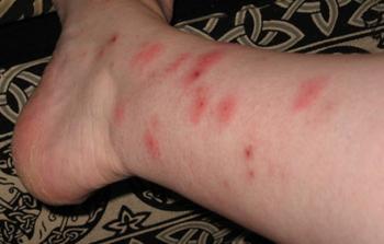 تسبب قرصات الحشرات احمرارًا وحكة شديدة