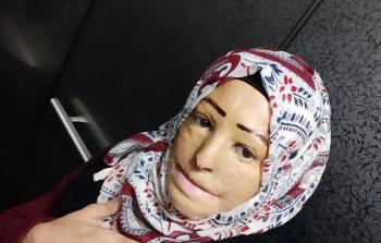 أمنيتها أن تجري عملية زراعة وجه بالكامل