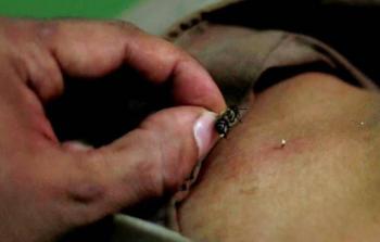 لا يوجد دليل علمي على فوائد العلاج بلسع النحل (رويترز)