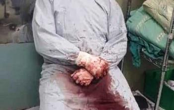 عاش البرش تجربة ثلاث حروب شنها الاحتلال على غزة