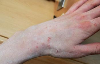 مصاب بمرض الجرب (أرشيف)