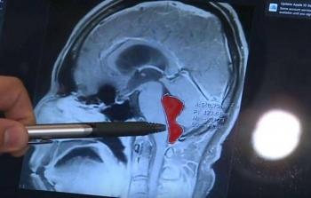 صورة الأشعة أثبتت وجود دودة في المخ