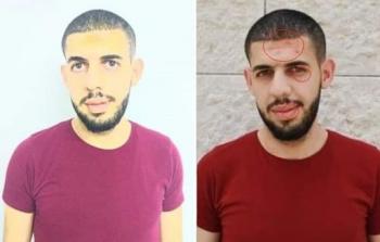 الصحفي أنس حواري وأثار كدمات واعتداء على وجهه أثناء اعتقاله