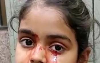 فتاة هندية تذرف دما بدل الدموع