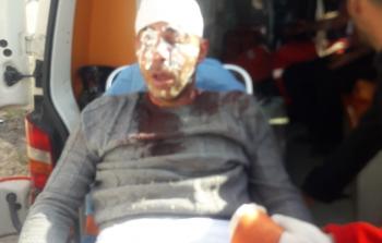 أحد الإصابات جراء اعتداءات المستوطنين