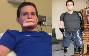 بكتيريا مرعبة فتكت بأطفال وبترت أطراف رجل جعلته بفم غريب
