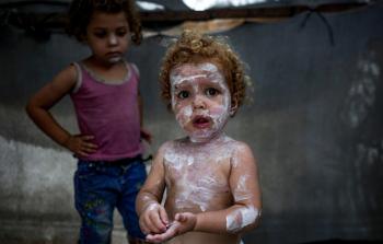 الأمراض الجلديِّ تنهش أجساد أطفال غزَّة