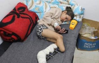 عمليَّات دون تخدير.. بأرقامٍ صادمة: غزَّة تسجِّل أكبر عدد من الأطفال مبتوري الأطراف في العالم