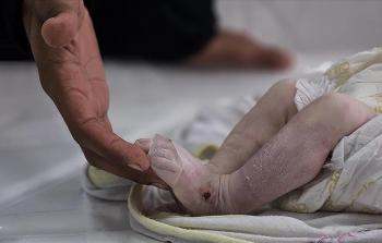 أطبَّاء بريطانيُّون: تفشِّي الأمراض وسوء التَّغذية يعرِّضان حياة الآلاف في غزَّة للموت