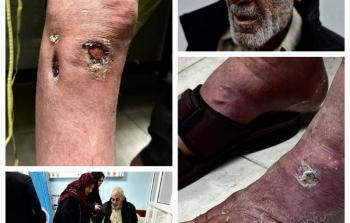 بالصور: أجساد الأسرى المحرَّرين شاهدةً على سنوات من التَّعذيب والتَّنكيل