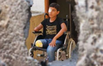 مركز الأطراف الصناعية: استقبلنا 600 حالة من مبتوري الأطراف بحرب غزَّة