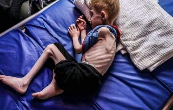 مدير مستشفى التحرير: نحو 600 ألف طفل مهددون بالموت جوعًا بغزة