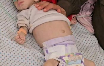 استشهاد رضيعة في غزَّة بسبب سوء التغذية