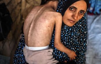 الأونروا: نفاد طعام الأطفال في غزَّة وكبار السِّنِّ يموتون بنقص الدَّواء