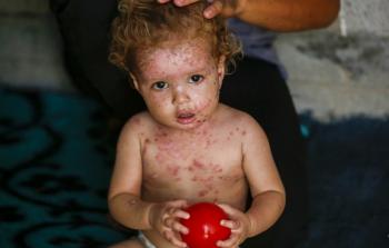 صرخات لا تُسمع.. الحصار يجلد أجساد الأطفال في غزة