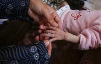 تزايد حالات تشوه الأجنة بسبب الأسلحة الإسرائيلية في غزة