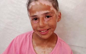 ضحيَّة للخوف في غزَّة... الطِّفلة لانا 