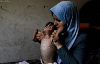 الأونروا: أكثر من 2700 طفل تحت سن الخامسة في غزَّة أصيبوا بسوء تغذية حاد