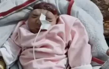 الطبيب البساينة: أطفال يُولدون دون جمجمة وبأطراف مشوهة في غزة