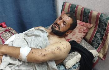 فؤاد أبو الحسنى.. القصفُ نقشَ خريطة للألم على وجهه وجسده