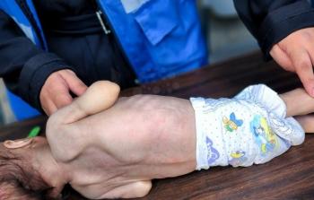 وفاة رضيع بغزة بسبب سوء التغذية ونقص حليب الأطفال