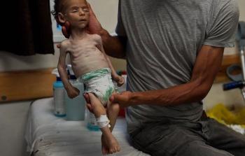 استشهاد طفلة في غزة بسبب الجوع وسوء التغذية