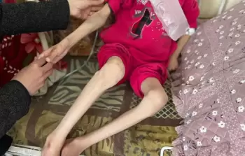 خلال 24 ساعة.. 18 حالة وفاة بسبب المجاعة في غزَّة