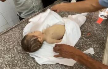 الطِّفلة مكَّة... ضحيَّة جديدة للمجاعة في غزَّة