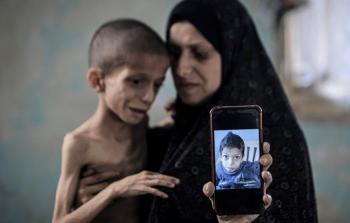 تقارير.. غزة تواجه تهديدًا قاتلًا مع انتشار الأمراض المقاومة للمضادات الحيوية