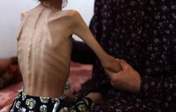 5 حالات وفاة جرَّاء المجاعة وسوء التَّغذية في غزَّة خلال الـ 24 ساعة الماضية