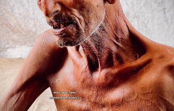 الثَّمانينيَّ سليم عصفور... جسدٌ يذبل تحت وطأة الحصار والمجاعة بغزة