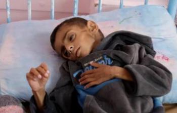 10 حالات وفاة نتيجة المجاعة وسوء التغذية خلال الـ 24 ساعة الماضية