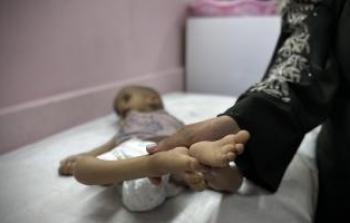 11 حالة وفاة نتيجة المجاعة وسوء التغذية خلال الـ 24 ساعة الماضية