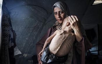 الصِّحَّة بغزَّة: 11 شهيدًا جراء التَّجويع وسوء التَّغذية خلال الـ24 ساعة الماضية