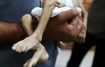 5 حالات وفاة جرَّاء المجاعة وسوء التَّغذية بغزة خلال الـ 24 ساعة الماضية