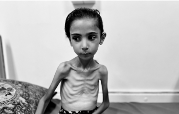 أمال البيوك.. طفلة تتحول إلى هيكل عظمي تحت وطأة المجاعة