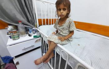 تساقط شعرها وبرزت عظامها.. المجاعة تنهش جسد الطفلة ميْ