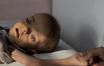 خلال الـ 24 ساعة الماضية.. 4 حالات وفاة جديدة نتيجة المجاعة وسوء التغذيةفي غزَّة