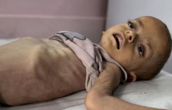 وفاة طفل نتيجة سوء التَّغذية والجوع الشديد في خانيونس