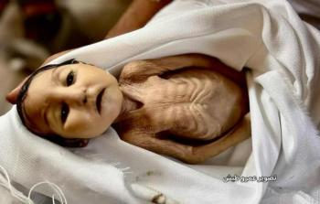 استشهاد الرضيعة غدير بريكة في خانيونس نتيجة سوء التغذية