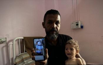 هزار عرفة.. طفلة تنهشها المجاعة وتصارع الموت في غزة